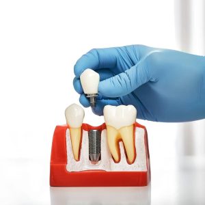 Restorative Dentistry London, ON